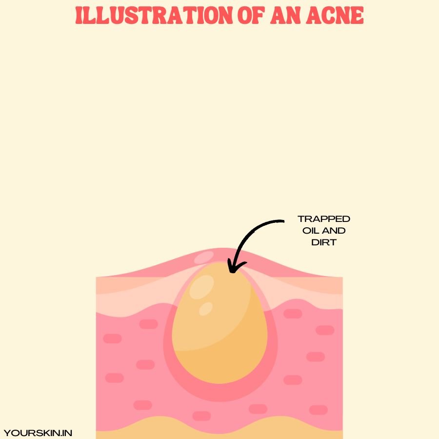 Illustration of an acne