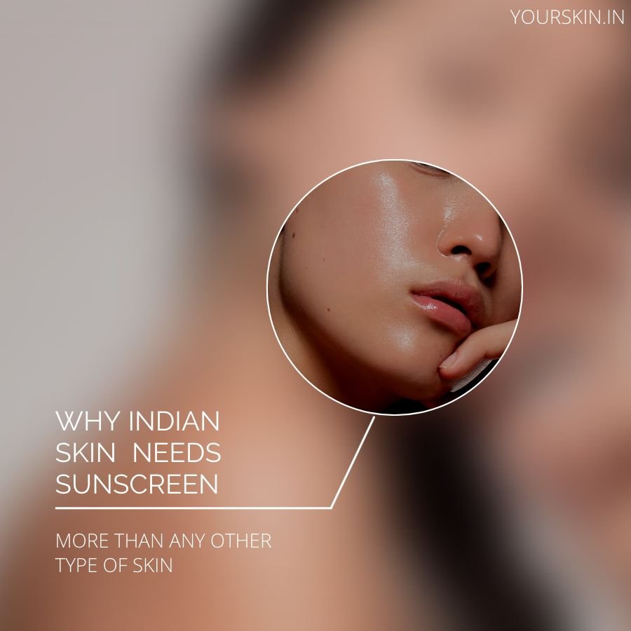 Why Indian skin needs to be careful about hyperpigmentation