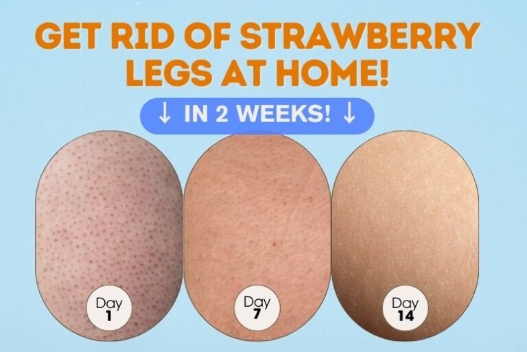 Get Rid of Strawberry Legs at Home:  Keratosis Pilaris Treatment and Prevention