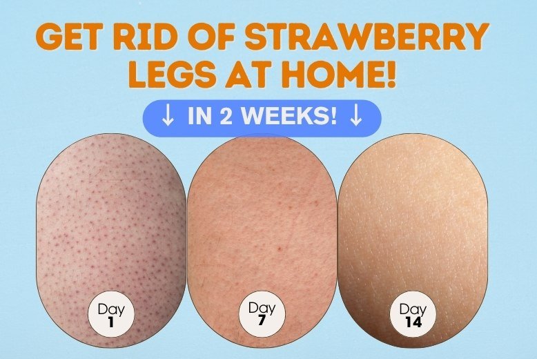 Strawberry legs transformation